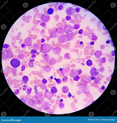 Blood Smear Of Leukemia Patient Under Microscope Stock Photo - Image: 60721196