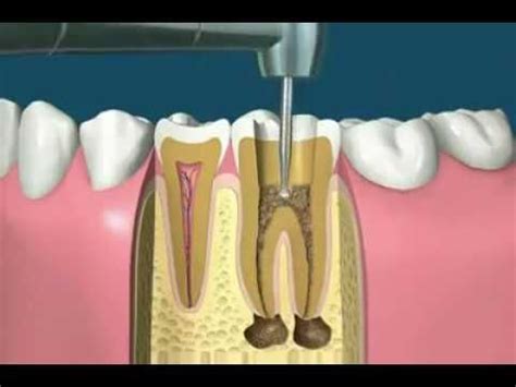 Endo-Crown. - YouTube | Dental hygienist jobs, Dental hygiene school, Dental treatment