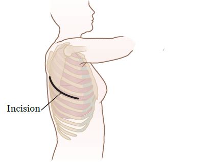 About Your Thoracic Surgery | Memorial Sloan Kettering Cancer Center