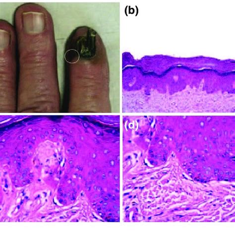 (a-d) Hutchinson's sign in melanoma, with epidermal pigmentation only... | Download Scientific ...