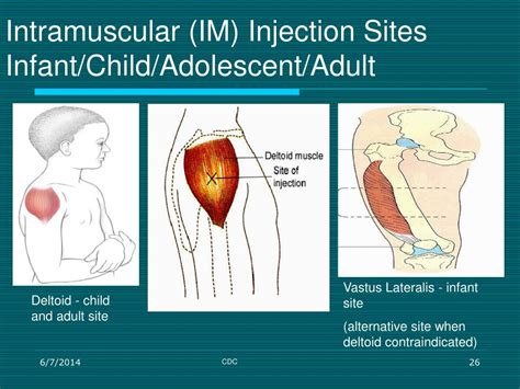 Landmarks For Intramuscular Injection