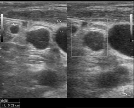 Tuberculous cervical lymphadenitis | Image | Radiopaedia.org