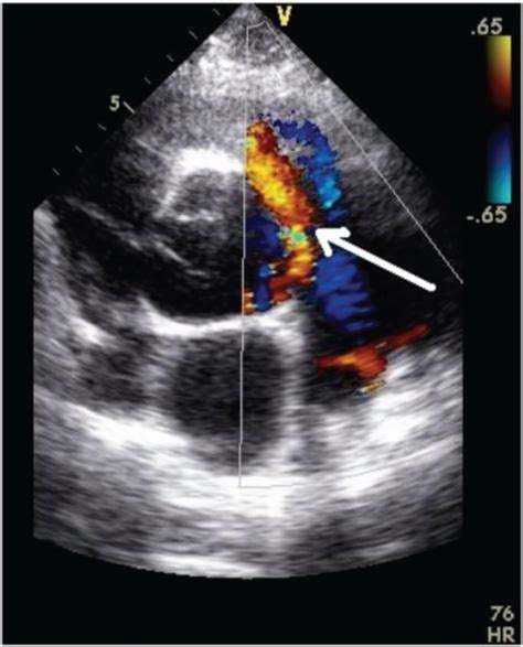 Transthoracic echocardiography image showing the patent ductus arteriosus (arrow).