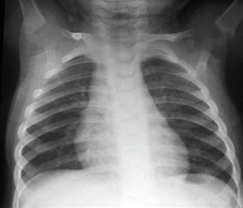 Healthy Chest X-ray Photograph by Zephyr/science Photo Library - Pixels