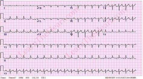 Atrial Tachycardia ECG (Example 1) | Learn the Heart