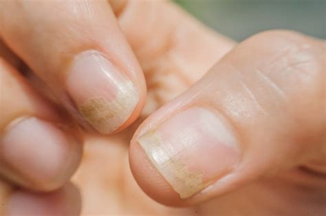 Nail Fungus Treatment, Causes & Symptoms | Clear Out Fungus