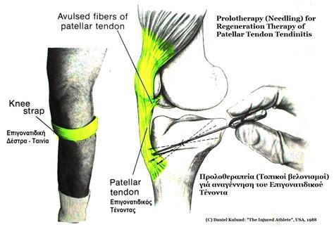 Important facts about Patellar Tendonitis and Shoulder Tendonitis - WriteWork