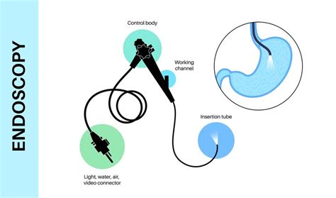 Premium Vector | Gastroscopy procedure Stomach diseases diagnostic GERD ...