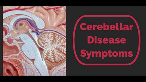 Cerebellar Disease Symptoms - YouTube