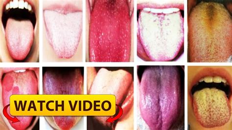 How the colour of your tongue reveals your health - YouTube