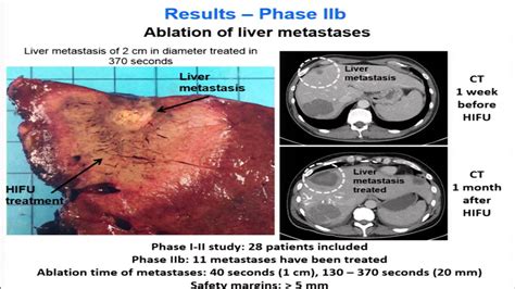 Melodelima - Clinical experience of intra-operative HIFU in colorectal ...