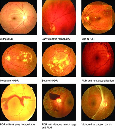 Details 300 background diabetic retinopathy - Abzlocal.mx