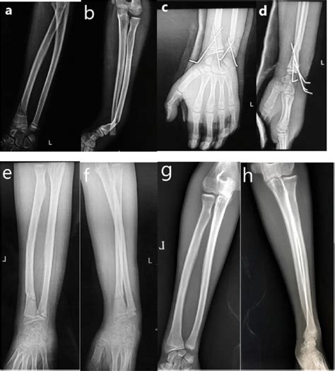 13-year-old boy with left distal radius-ulna fracture treated with... | Download Scientific Diagram