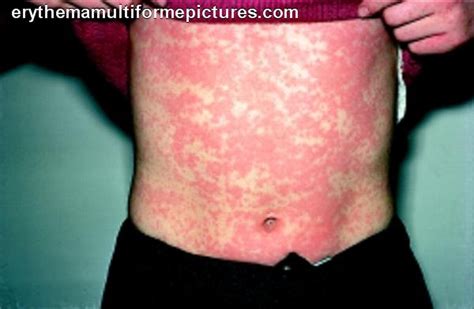 serum sickness treatment - pictures, photos