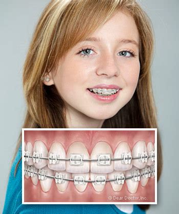 Types of Braces (Fixed Appliances) | Orthodontics of the Southern Tier | Binghamton NY