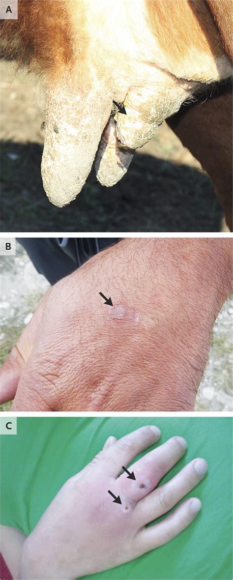 Human Infection with a Zoonotic Orthopoxvirus in the Country of Georgia ...