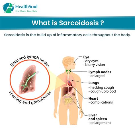 Sarcoidosis: Symptoms, Diagnosis and Treatment – Healthsoul