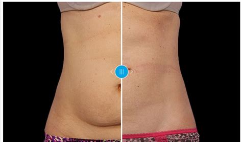 coolsculpting cost Archives - CoolSculpting | Freeze the Fat Beverly Hills