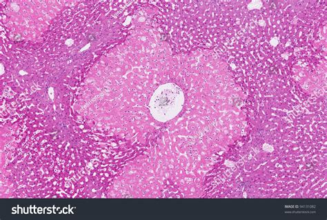 Acute Necrosis (Cell Death) Of The Liver Cells - The Wide Uniform Band ...