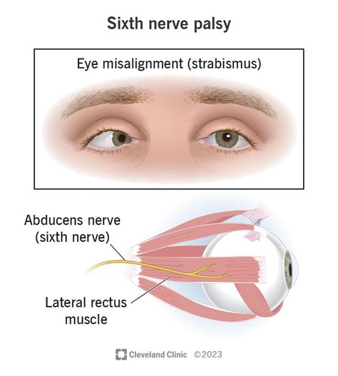 Sixth Nerve Palsy: Causes, Symptoms & Treatment