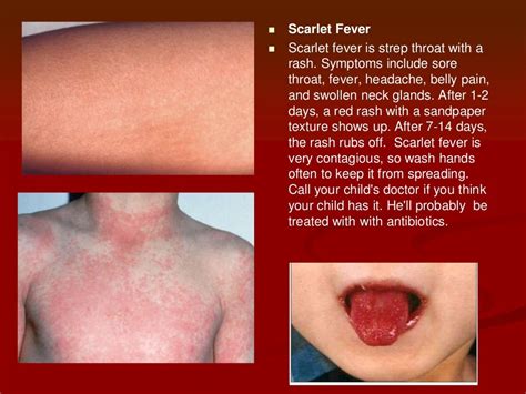 evaluating a child with febrile rash