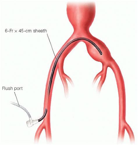 Advanced Aneurysm Management Techniques: Management of Internal Iliac Aneurysm Disease ...