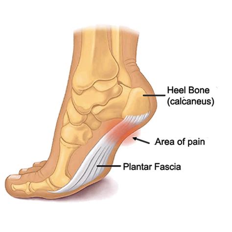 Plantar Fasciitis - Brampton Foot Clinic