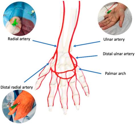 JCM | Free Full-Text | Radial Artery Access for Percutaneous Cardiovascular Interventions ...