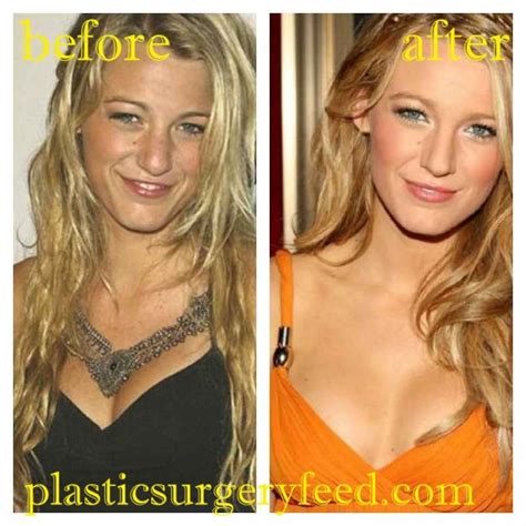 Blake Lively Plastic Surgery - Plastic Surgery Feed