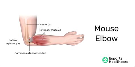 Tendinopathy from gaming: eliminating the #1 career killing ailment – Esports Healthcare