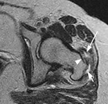 Gluteus Minimus Tear & Trochanteric Bursitis | Radsource