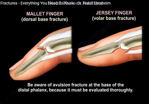 Distal Phalanx Fractures — OrthopaedicPrinciples.com