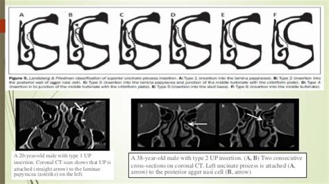 Surgical anatomy of osteomeatal complex