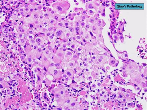 Mesothelioma Histology