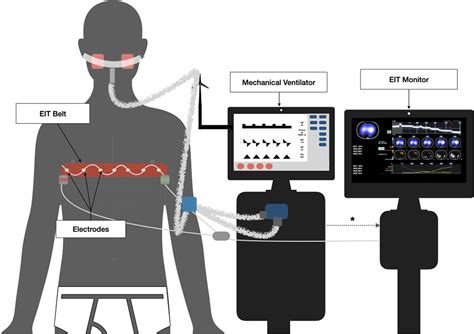 Electrical Impedance Tomography in Acute Respiratory Distres ...