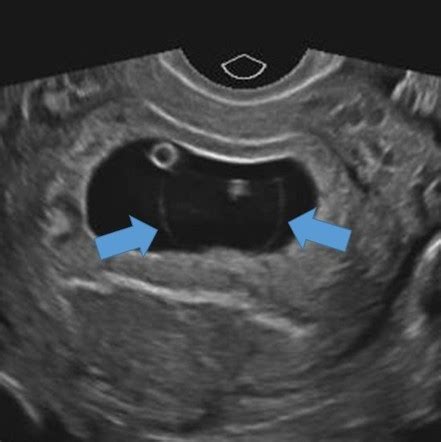 Amniotic Sac Ultrasound