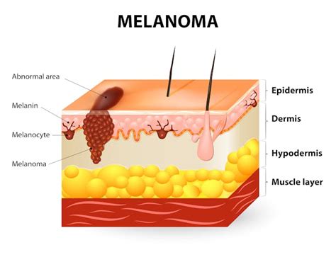 Sun damage and cancer: how UV radiation affects our skin