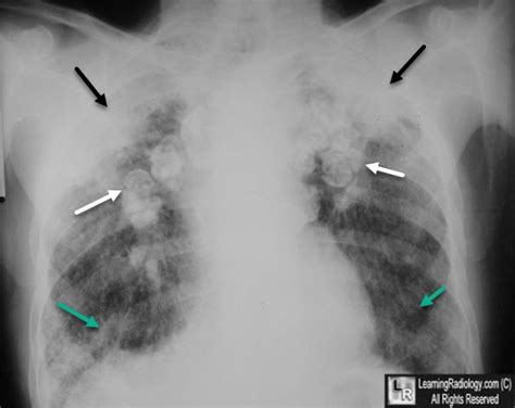 LearningRadiology - Silicosis