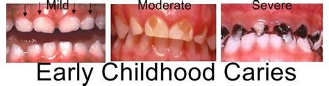 Baby Bottle Tooth Decay, or Early Childhood Caries (EEC) is most common in the upper front teeth ...