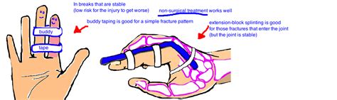 Broken Finger (phalanx fracture) — Bone Talks