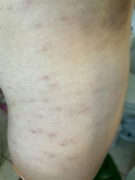 Tips for staph infection scars/dark spots? (27F with full body staph infection from the gym ...