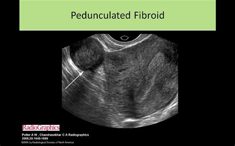 pedunculated fibroid Ultrasound Sonography, Medical Mnemonics, Gyno ...