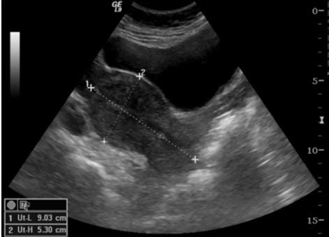 Pelvic Ultrasound Quick Reference Guide for Patients