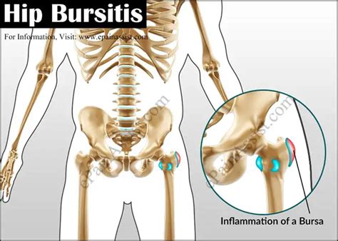 Hip Bursitis or Trochanteric Bursitis | Causes | Symptoms | Treatment | Exercises