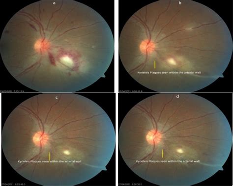 (a) Fundus photo of toxoplasma retinochoroiditis on presentation with ...