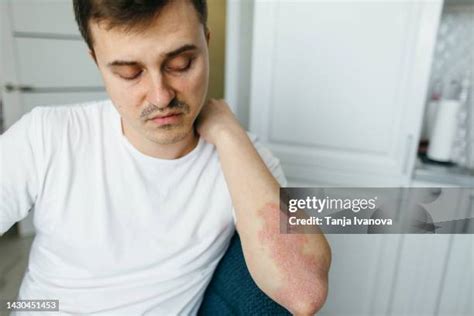 Eczema Man Photos and Premium High Res Pictures - Getty Images