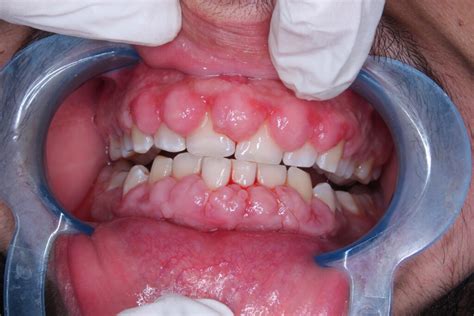 Gingival Hyperplasia (Gum Overgrowth)