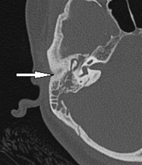 AOM: Axial image shows soft tissue density in mastoid antrum , air... | Download Scientific Diagram