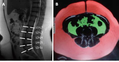 Subcutaneous and visceral fat measurement technique. A: Sagittal... | Download Scientific Diagram