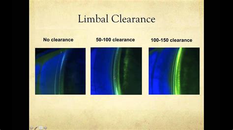 Scleral Lens Fitting Basics May 13, 2015 - YouTube